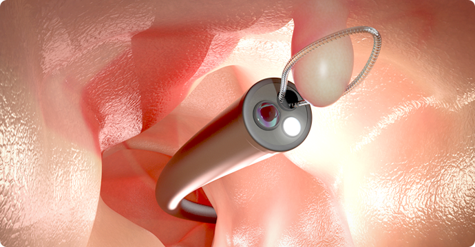 日帰り大腸ポリープ切除に対応